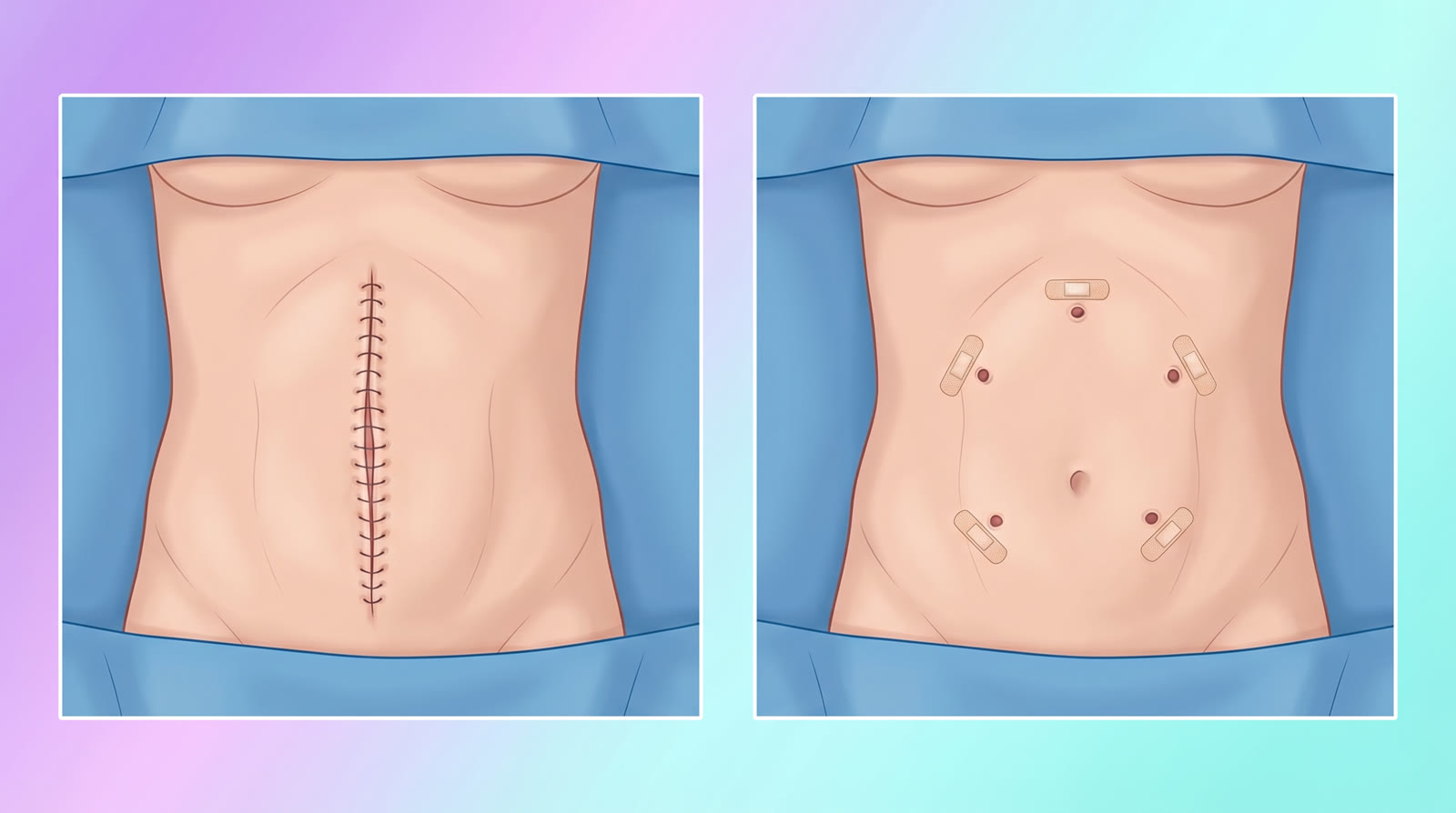 Açık cerrahi büyük kesi vs robotik cerrahi 5 küçük port — karşılaştırmalı görsel